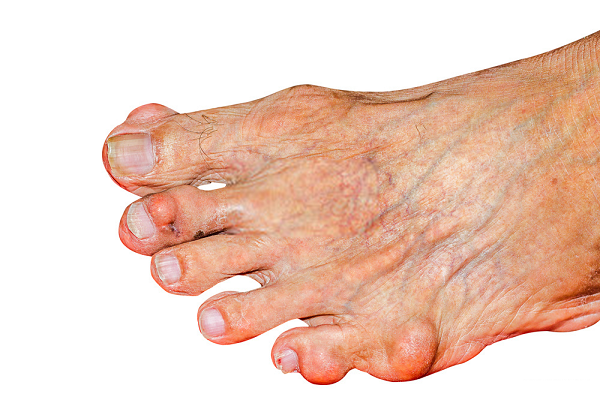 Bệnh gout là bệnh phổ biến trong xã hội hiện đại